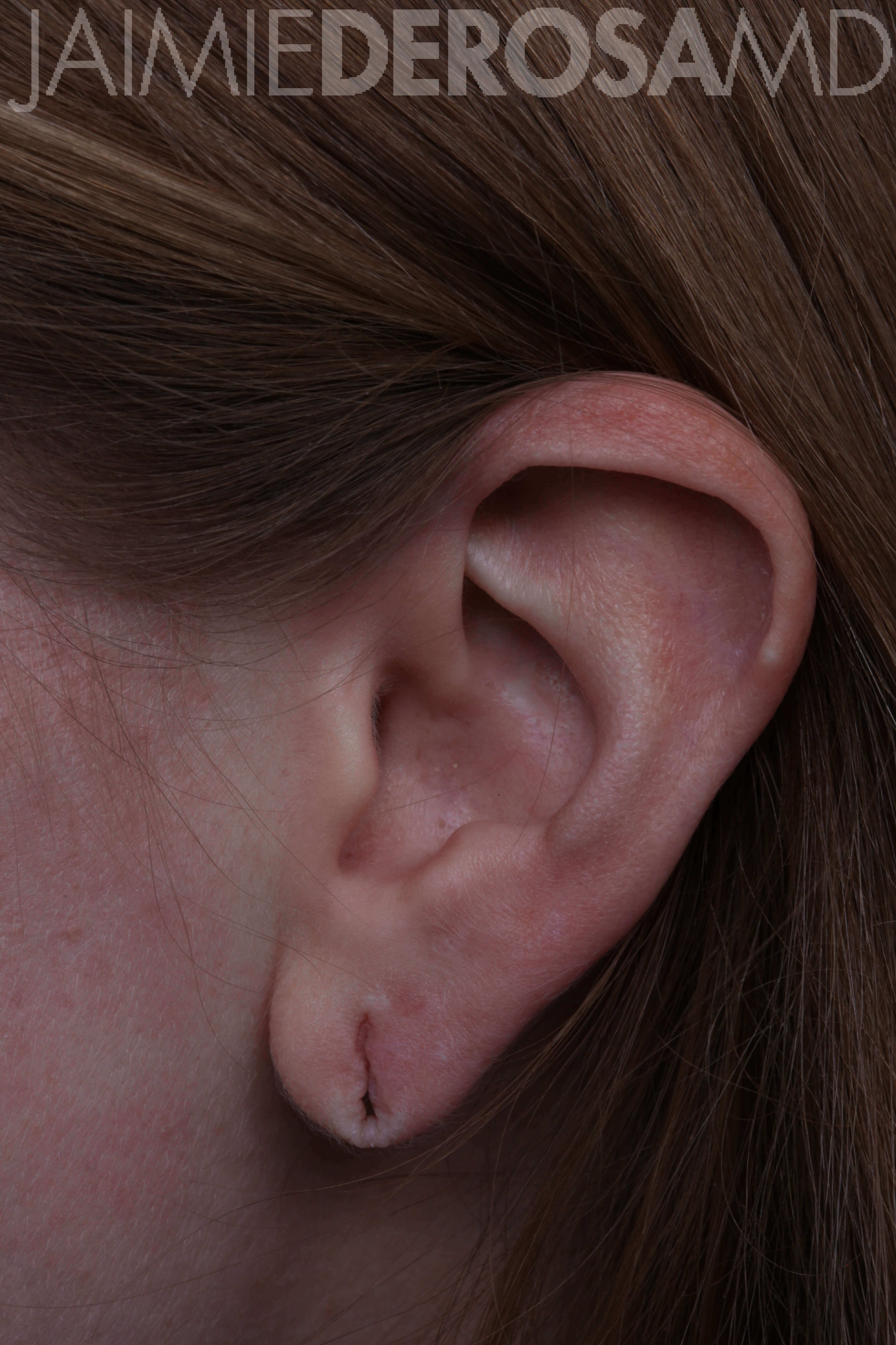 Boston Woman Has Her Stretched Earlobe Piercings Repaired 7344